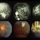 Eales Disease Eales Disease